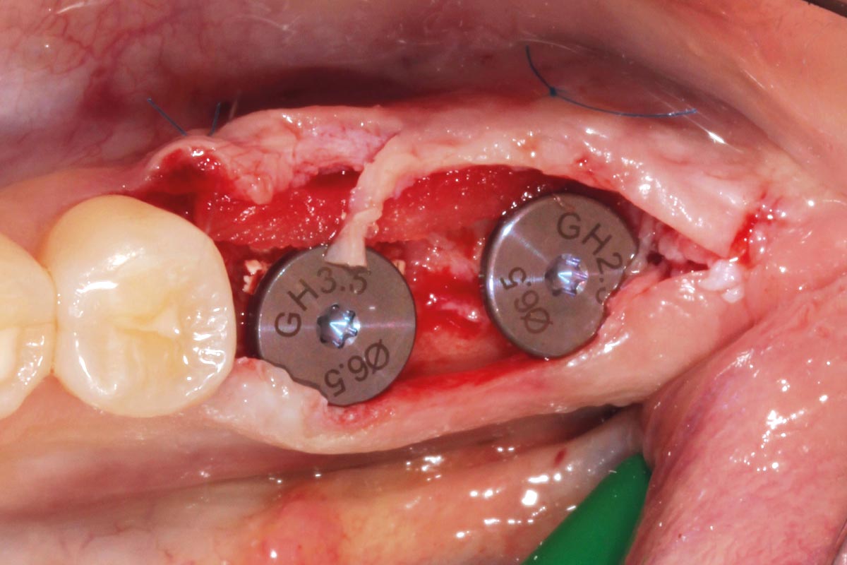 Buccal soft tissue augmentation with mucoderm® to increase thickness, followed by placement of healing abutments for open healing.