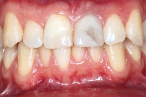 Preoperative clinical situation with a non-restorable maxillary central incisor