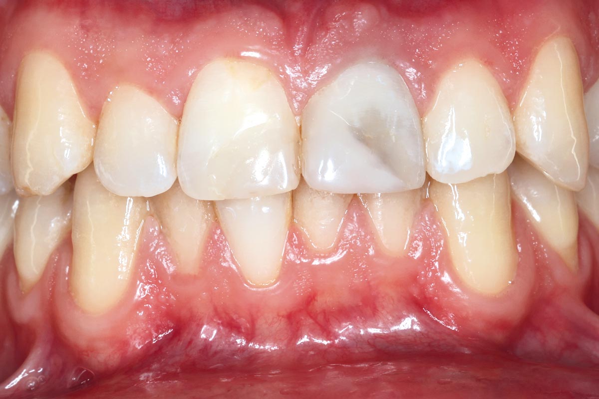 Preoperative clinical situation with a non-restorable maxillary central incisor