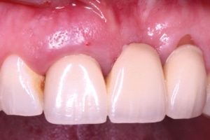 Initial clinical situation: Soft tissue deficiency in the maxillary anterior aesthetic zone