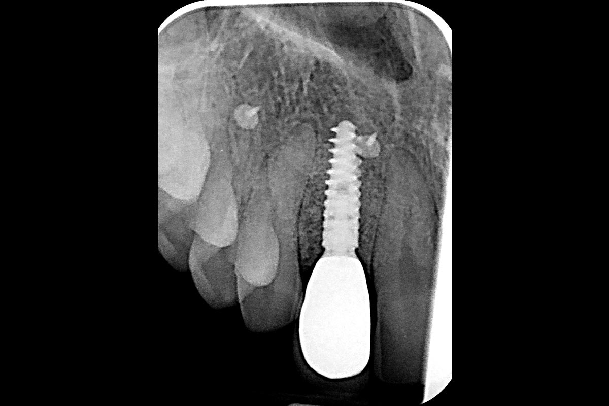 X-Ray taken at the time of placement demonstrating passive fit and stable surrounding peri-implant bone