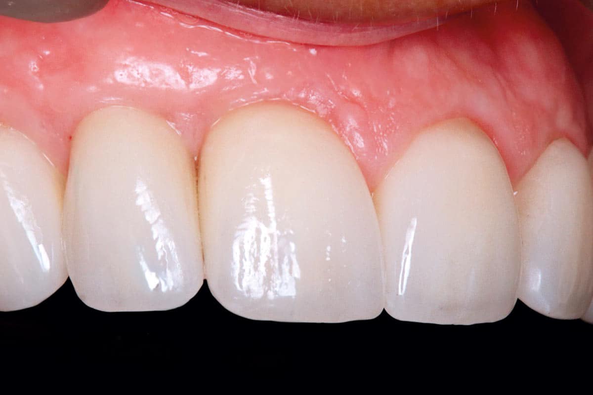 3-month follow-up: Lateral view demonstrating stable peri-implant soft tissue contour and papilla growth around the implant crown