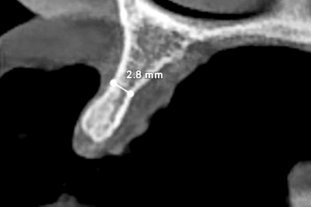 CBCT demonstrating the reduced ridge dimensions at the planned treatment site
