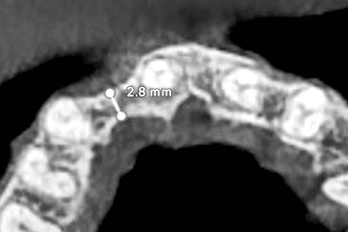 CBCT demonstrating the reduced ridge dimensions at the planned treatment site