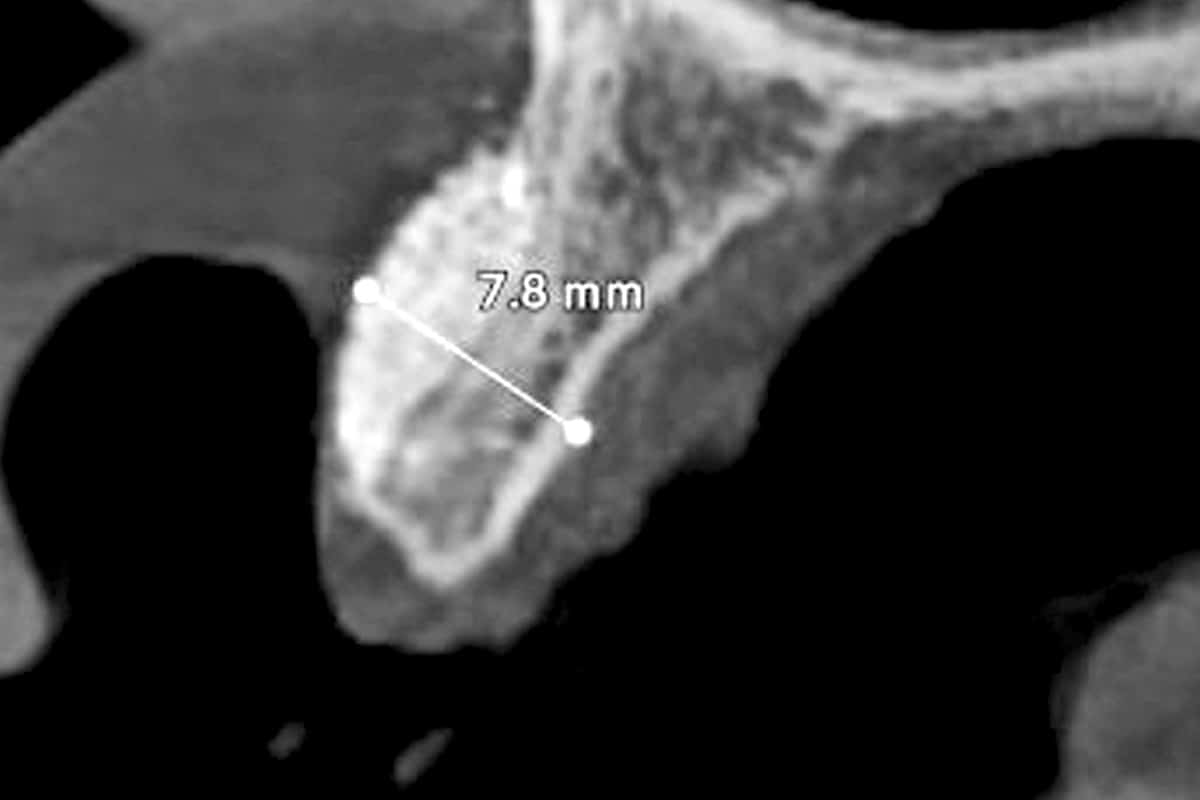 CBCT assessment after 8 months of healing demonstrating favourable ridge contour prior to implant placement