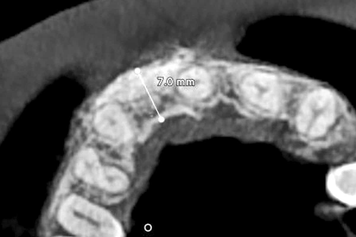 CBCT assessment after 8 months of healing demonstrating favourable ridge contour prior to implant placement